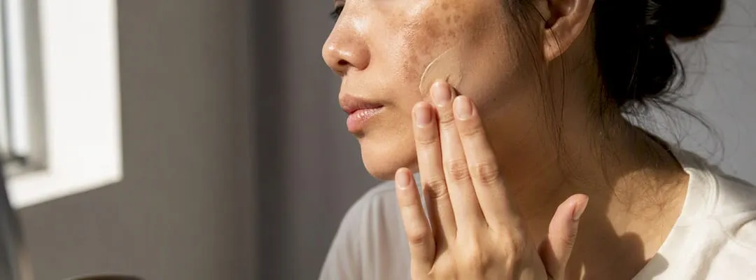 K-Beauty contro il Melasma: Cosa possono davvero fare gli ingredienti attivi