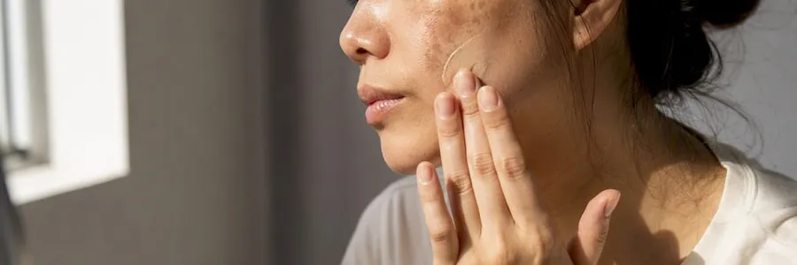K-Beauty gegen Melasma: Was Wirkstoffe wirklich leisten