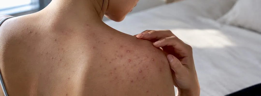 Soins contre l'acné à Malassezia : Ce qui aide vraiment contre l'acné fongique