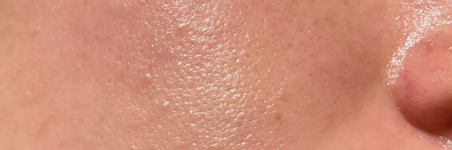 Fettige Haut ist besser als ihr Ruf